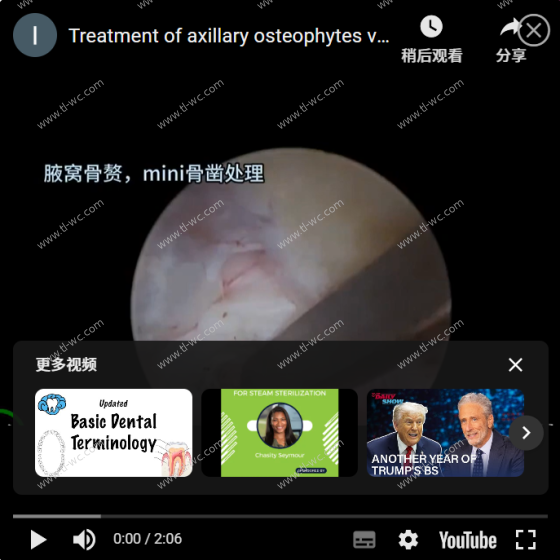 UBE surgery: Cervical corner approach keyhole, axillary osteophyte treatment, mini Angle bone knife and small grinding head