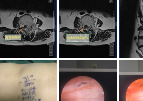 Percutaneous Endoscopic Lumbar Discectomy